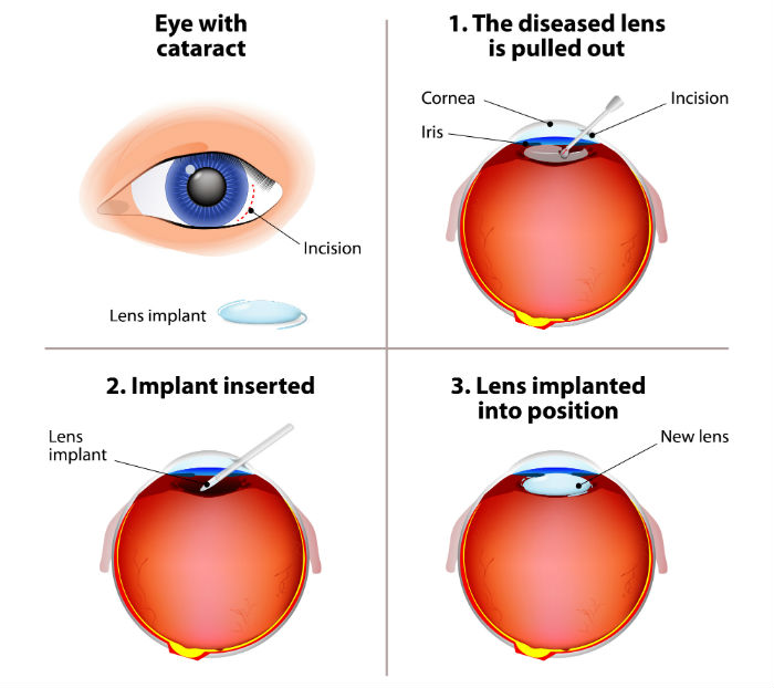 cataractsurgery