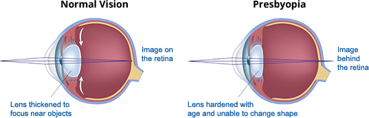 presbyopia-diagram