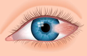 pterygium