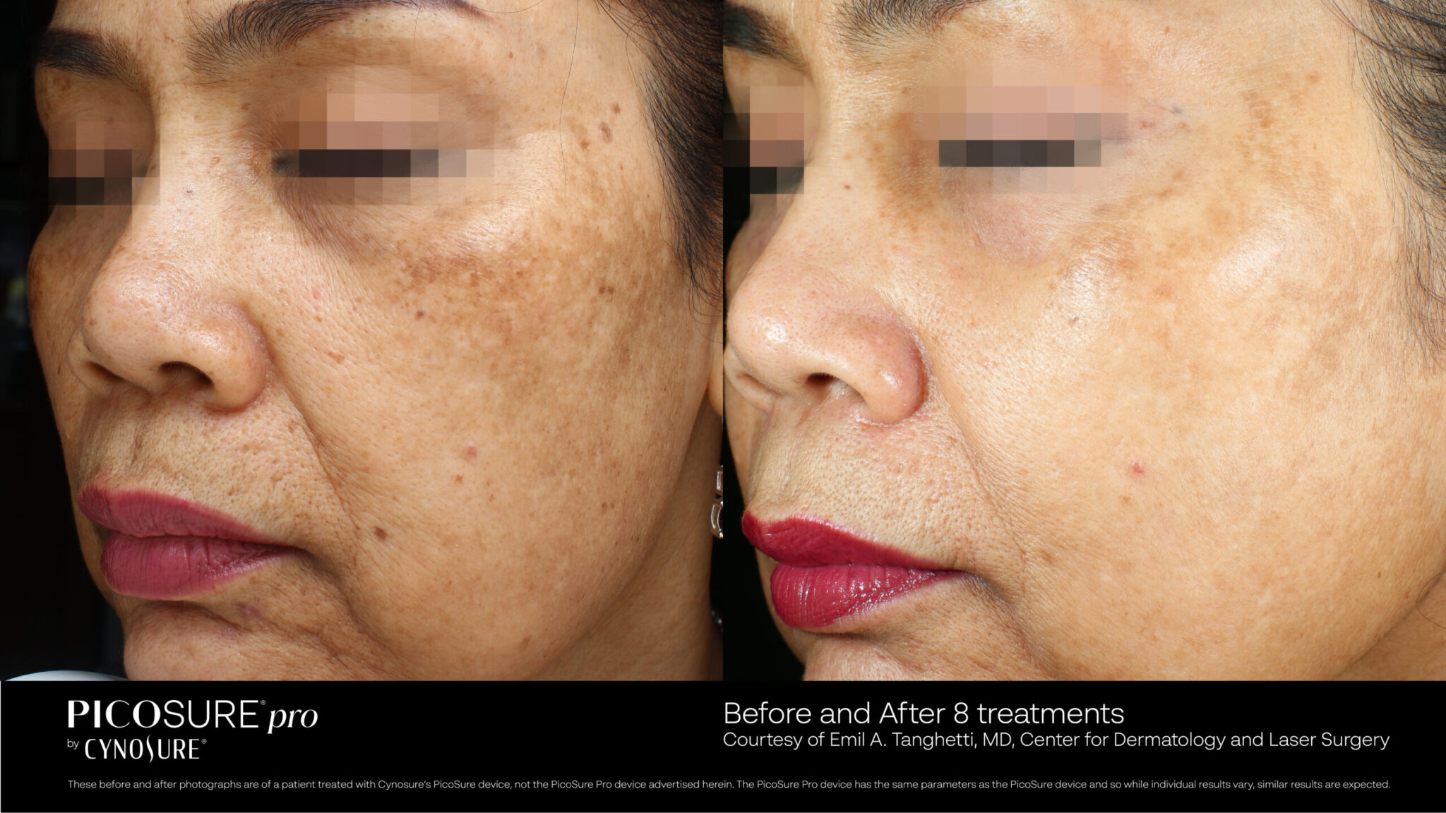 PicoSure Skin Rejuvenation & Laser Tattoo Removal Honolulu HI